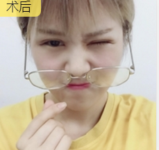 重庆超雅超声波双眼皮手术让你成为心目中的女神676
