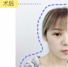重庆超雅超声波双眼皮手术让你成为心目中的女神676