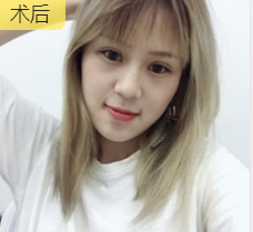 重庆超雅超声波双眼皮手术让你成为心目中的女神676