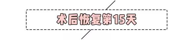 重庆超雅超声波双眼皮手术让你成为心目中的女神676