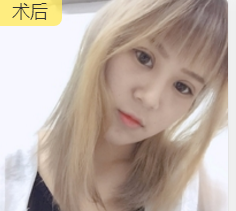 重庆超雅超声波双眼皮手术让你成为心目中的女神676