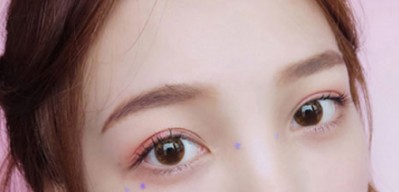 一名小网红超声波双眼皮后的变化分享074 一名小网红超声波双眼皮后的变化分享074