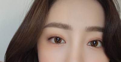 一名小网红超声波双眼皮后的变化分享074 一名小网红超声波双眼皮后的变化分享074