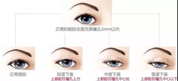 重庆超雅双眼皮手术带来的惊喜绝对大!079 重庆超雅双眼皮手术带来的惊喜绝对大!079