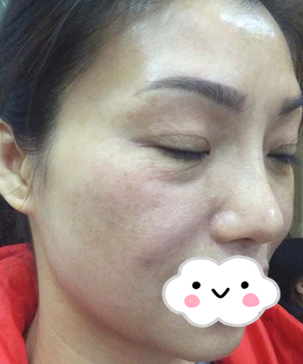 重庆超雅不开刀下巴延长术，没想到恢复的效果这么好770