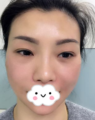 重庆超雅不开刀下巴延长术，没想到恢复的效果这么好770