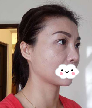 重庆超雅不开刀下巴延长术，没想到恢复的效果这么好770