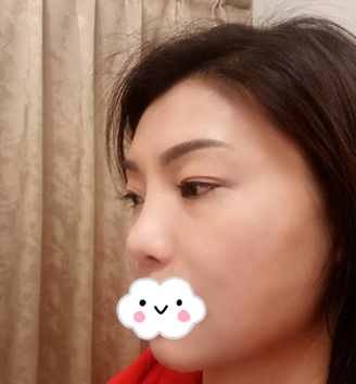重庆超雅不开刀下巴延长术，没想到恢复的效果这么好770
