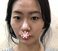 重庆超雅双眼皮手术经典案例来袭264 重庆超雅双眼皮手术经典案例来袭264