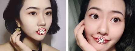 重庆超雅双眼皮手术经典案例来袭264 重庆超雅双眼皮手术经典案例来袭264