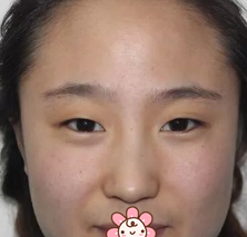 重庆超雅双眼皮手术经典案例来袭264 重庆超雅双眼皮手术经典案例来袭264