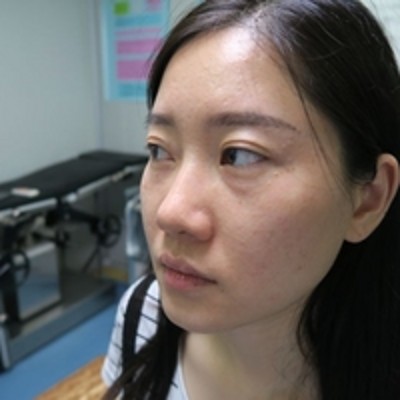 重庆超雅超 声 波去眼袋,眼袋消失le真得很漂亮 重庆超雅超 声 波去眼袋,眼袋消失le真得很漂亮
