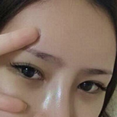 超声波去眼袋一个小手术，解决你眼袋的大问题！755
