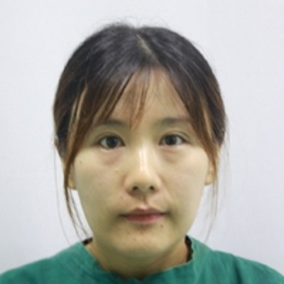 重庆超雅超声波去眼袋，没有了眼袋化妆得心应手了808