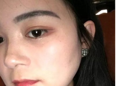 “过来人”推荐双眼 皮手术——超 声 波双眼 皮！
