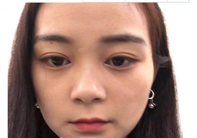 “过来人”推荐双眼 皮手术——超 声 波双眼 皮！