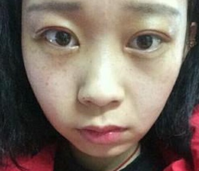 “梁氏双眼皮公式”做出来的双眼皮就是好看!533 “梁氏双眼皮公式”做出来的双眼皮就是好看!533