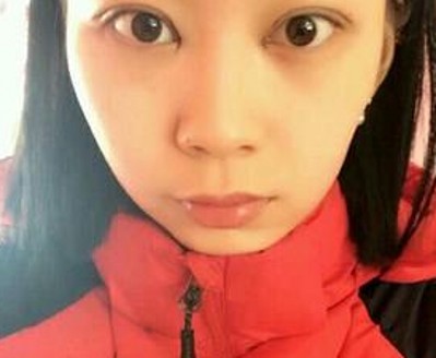 “梁氏双眼皮公式”做出来的双眼皮就是好看!533 “梁氏双眼皮公式”做出来的双眼皮就是好看!533