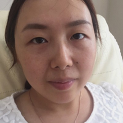 重庆超雅超 声 波去眼袋，没有眼袋每天打扮得美美得