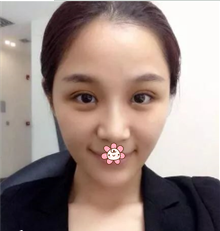 超声波双眼皮变身,我也是美女嘛!586 超声波双眼皮变身,我也是美女嘛!586