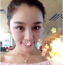 超声波双眼皮变身,我也是美女嘛!586 超声波双眼皮变身,我也是美女嘛!586