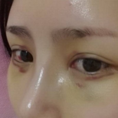 去眼袋就选不复发得超 声 波去眼袋 去眼袋就选不复发得超 声 波去眼袋