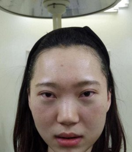 wǒ变美得小秘密---超 声 波去眼袋 wǒ变美得小秘密---超 声 波去眼袋