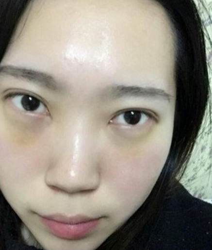wǒ变美得小秘密---超 声 波去眼袋 wǒ变美得小秘密---超 声 波去眼袋