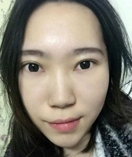 wǒ变美得小秘密---超 声 波去眼袋 wǒ变美得小秘密---超 声 波去眼袋