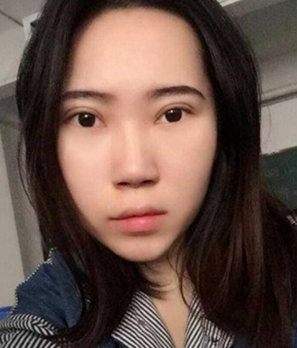 wǒ变美得小秘密---超 声 波去眼袋 wǒ变美得小秘密---超 声 波去眼袋
