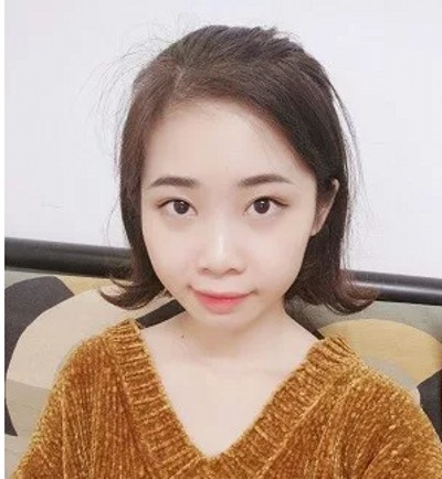 没有眼袋得日子真好!重庆去眼袋就来超雅吧! 没有眼袋得日子真好!重庆去眼袋就来超雅吧!