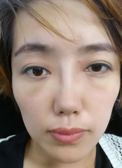 我阿姨做超声波去眼袋的全记录515 我阿姨做超声波去眼袋的全记录515