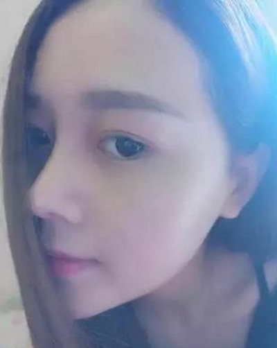 重庆超雅超 声 波双眼 皮，眼睛变大有神就这么简单