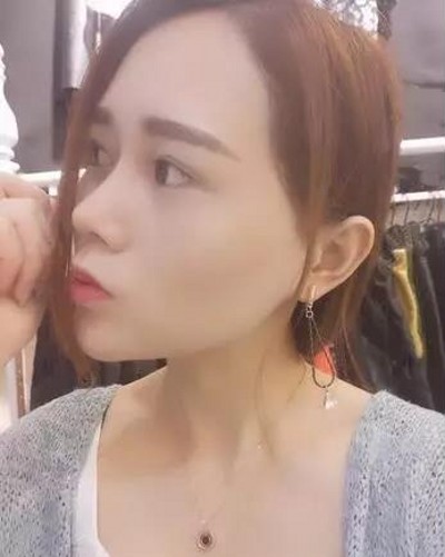重庆超雅超 声 波双眼 皮，眼睛变大有神就这么简单