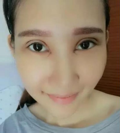 美美的眼睛美美的心情超声波双眼皮126 美美的眼睛美美的心情超声波双眼皮126