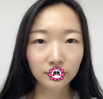 重庆超雅双眼 皮手术,点赞!! 重庆超雅双眼 皮手术,点赞!!