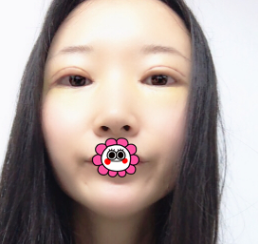 重庆超雅双眼 皮手术,点赞!! 重庆超雅双眼 皮手术,点赞!!