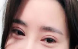 重庆超雅双眼 皮手术,点赞!! 重庆超雅双眼 皮手术,点赞!!