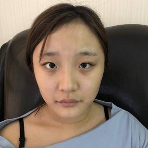 告别平凡,在重庆做到了超声波双眼皮手术634 告别平凡,在重庆做到了超声波双眼皮手术634