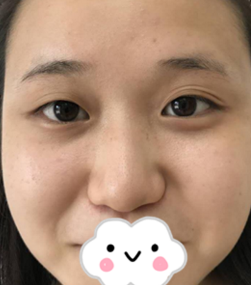 重庆超雅双眼皮手术真的美到自然啊!222 重庆超雅双眼皮手术真的美到自然啊!222