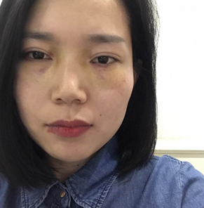 重庆超雅去眼袋手术,让你告别美颜相机!!042 重庆超雅去眼袋手术,让你告别美颜相机!!042