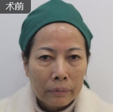 重庆超雅超声波去眼袋手术给你想要的眼睛!362 重庆超雅超声波去眼袋手术给你想要的眼睛!362