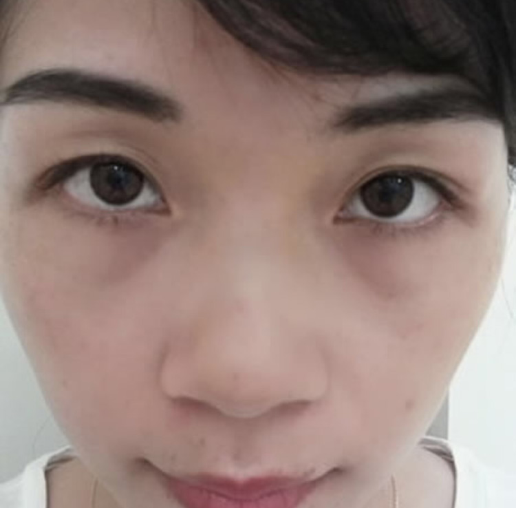 超声波去眼袋漂亮的选择,biubiubiu823 超声波去眼袋漂亮的选择,biubiubiu823