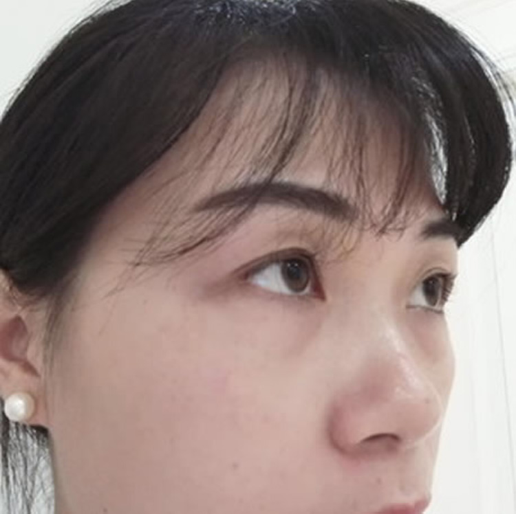 超声波去眼袋漂亮的选择,biubiubiu823 超声波去眼袋漂亮的选择,biubiubiu823
