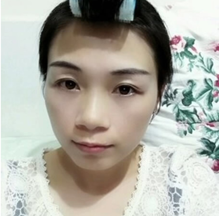 超声波去眼袋漂亮的选择,biubiubiu823 超声波去眼袋漂亮的选择,biubiubiu823