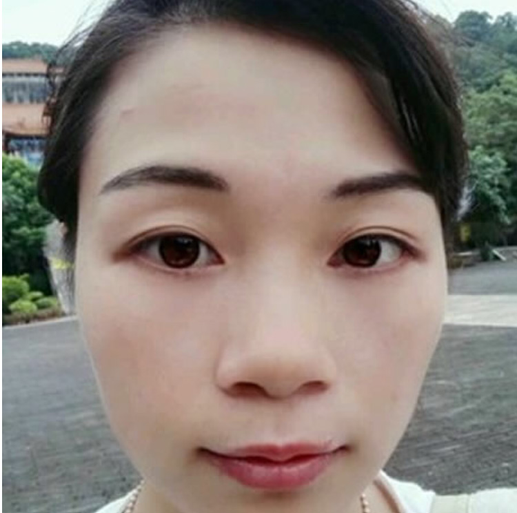 超声波去眼袋漂亮的选择,biubiubiu823 超声波去眼袋漂亮的选择,biubiubiu823