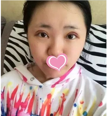 超 声 波双眼 皮不shì美，shì很美！