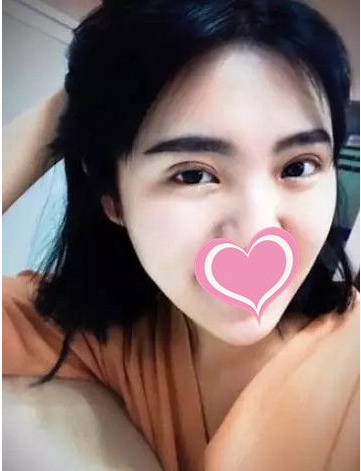 超 声 波双眼 皮不shì美，shì很美！