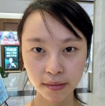超声波双眼皮,为我们的美丽事业加分585 超声波双眼皮,为我们的美丽事业加分585
