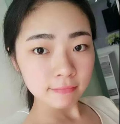 梁医生为我制定了与眼型相对应的超声波双眼皮826 梁医生为我制定了与眼型相对应的超声波双眼皮826